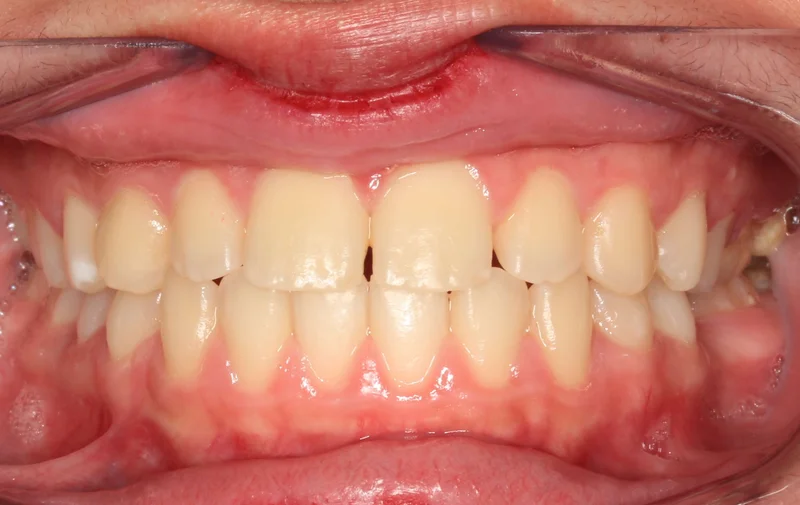 Center Bite - Before Treatment