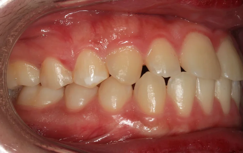 Right Buccal - Before Treatment