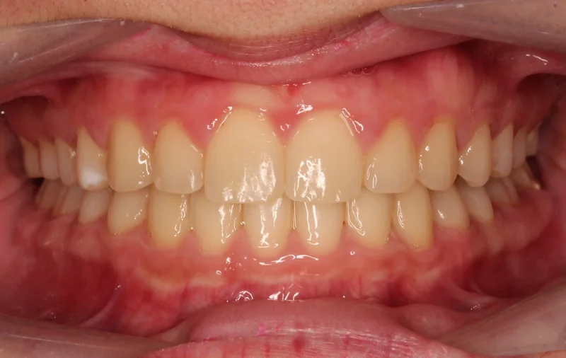 Center Bite - After Treatment