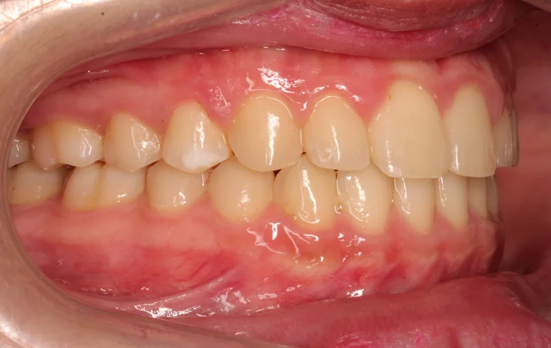 Right Buccal - After Treatment
