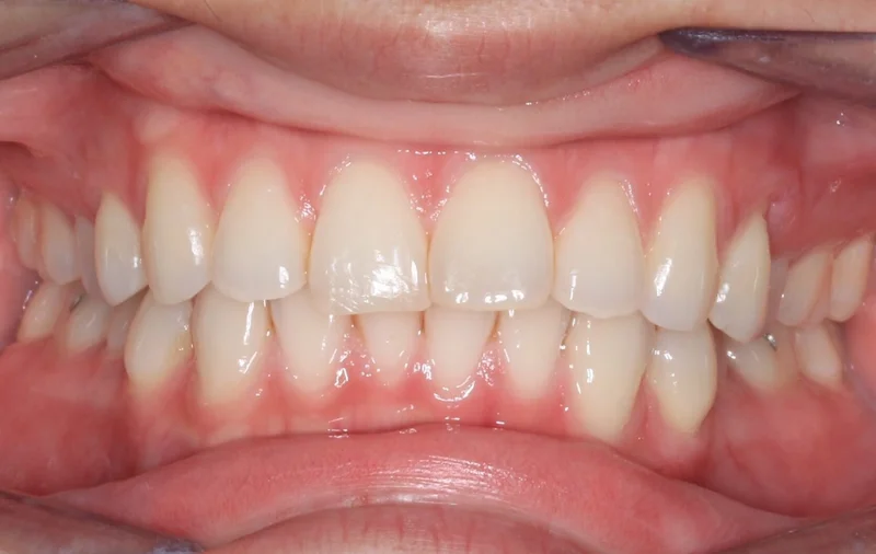 Center Bite - Before Treatment