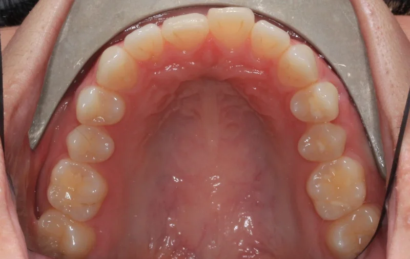 Upper Occlusal - Before Treatment
