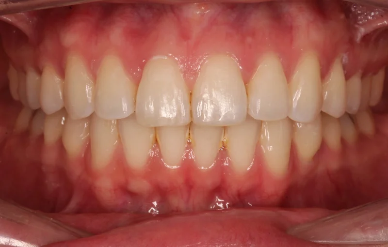 Center Bite - After Treatment