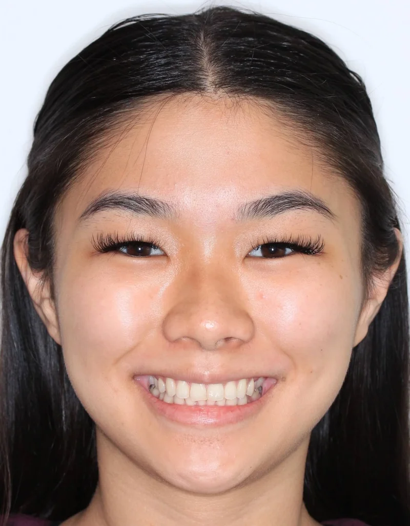 Facial Smiling - Before Treatment