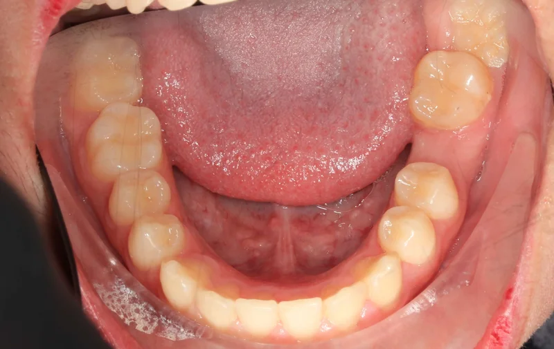 Lower Occlusal - Before Treatment