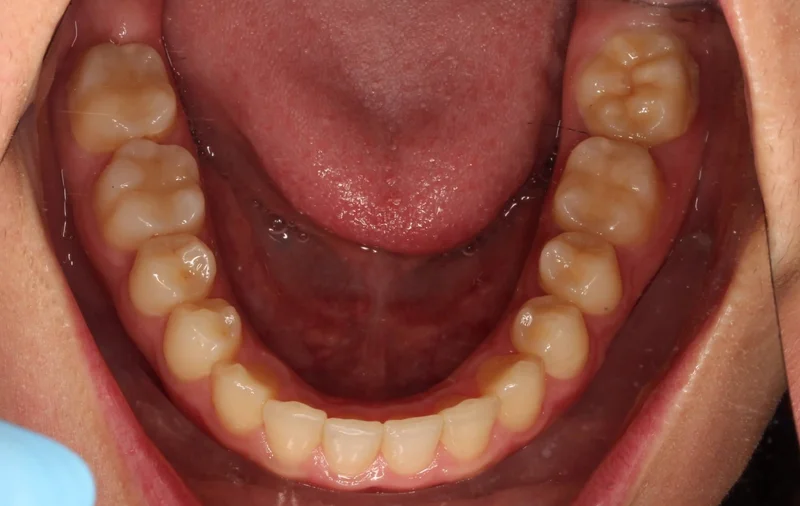 Lower Occlusal - After Treatment