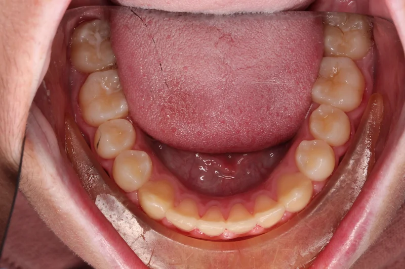 Lower Occlusal - After Treatment