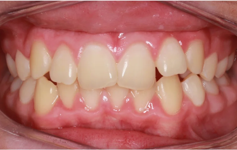 Center Bite - Before Treatment