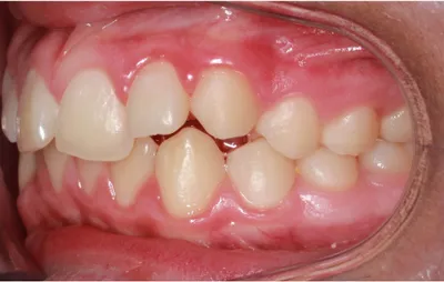 Before Metal Braces treatment - Case 84790