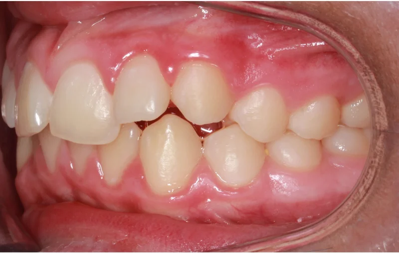 Left Buccal - Before Treatment