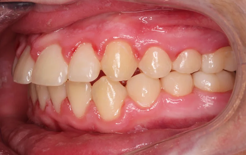 Left Buccal - After Treatment