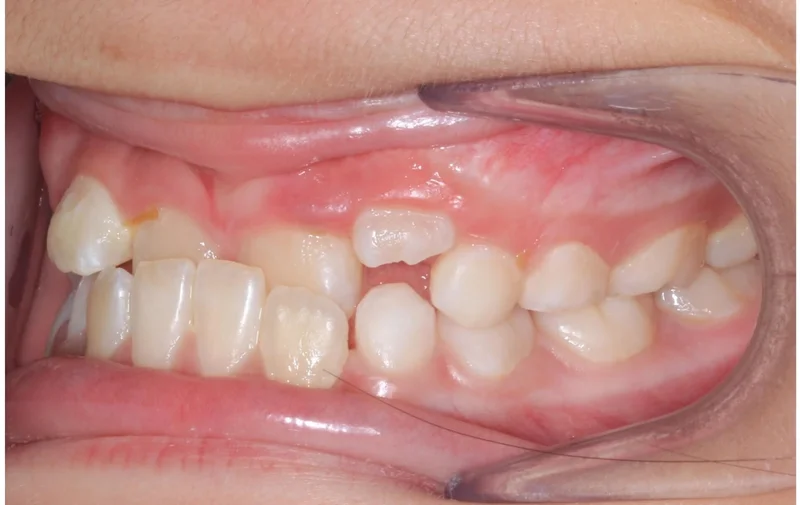 Left Buccal - Before Treatment