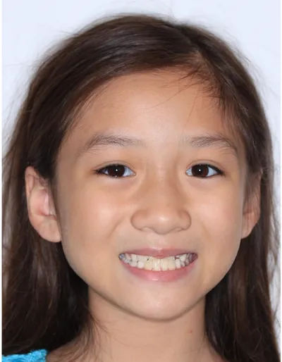 Before Metal Braces treatment - Case 84847