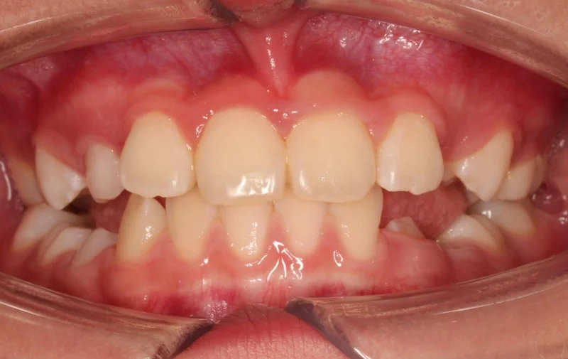 Center Bite - After Treatment