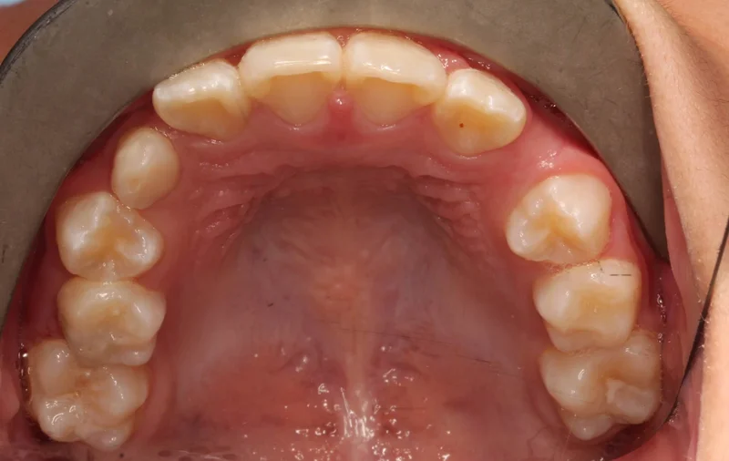 Upper Occlusal - After Treatment