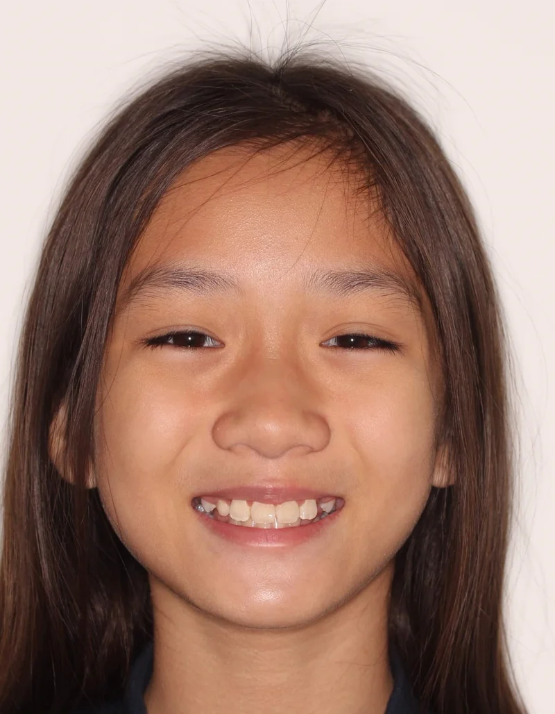 Facial Smiling - After Treatment