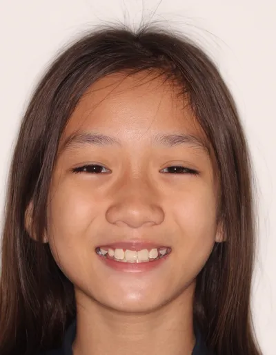 After Metal Braces treatment - Case 84847