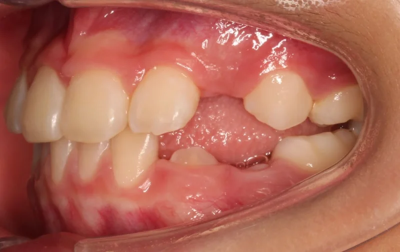 Left Buccal - After Treatment