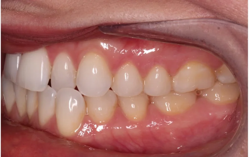 Left Buccal - Before Treatment