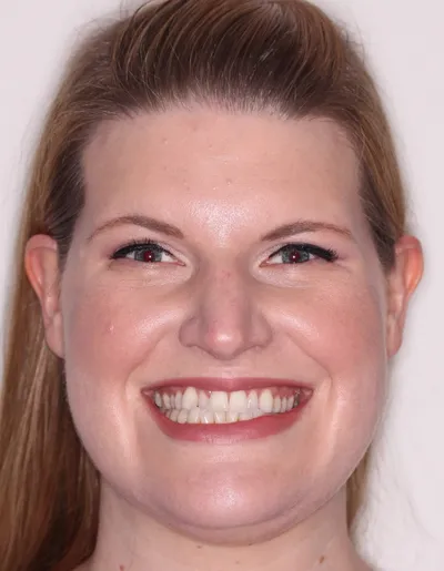 Before Clear Aligners treatment - Case 85058