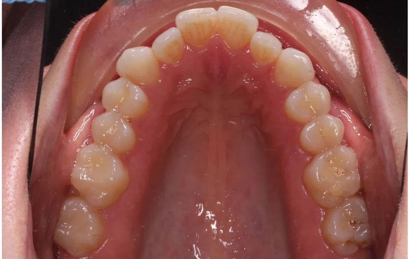 Upper Occlusal - Before Treatment