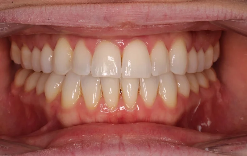 Center Bite - After Treatment
