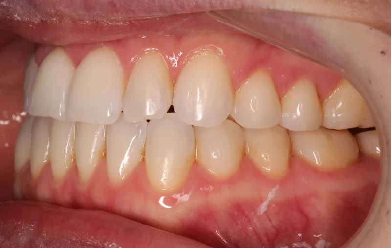 Left Buccal - After Treatment
