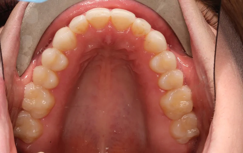 Upper Occlusal - After Treatment