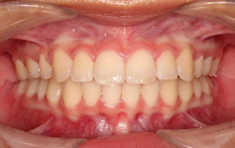 Center Bite - After Treatment
