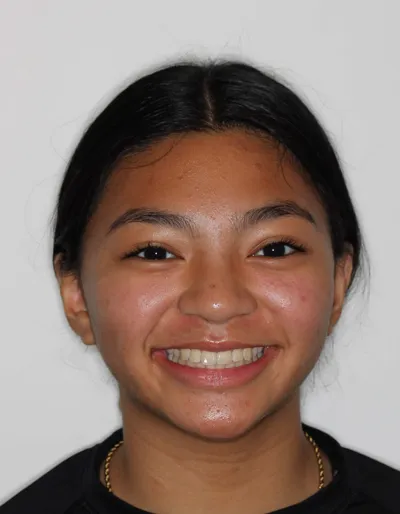 After Metal Braces treatment - Case 85061