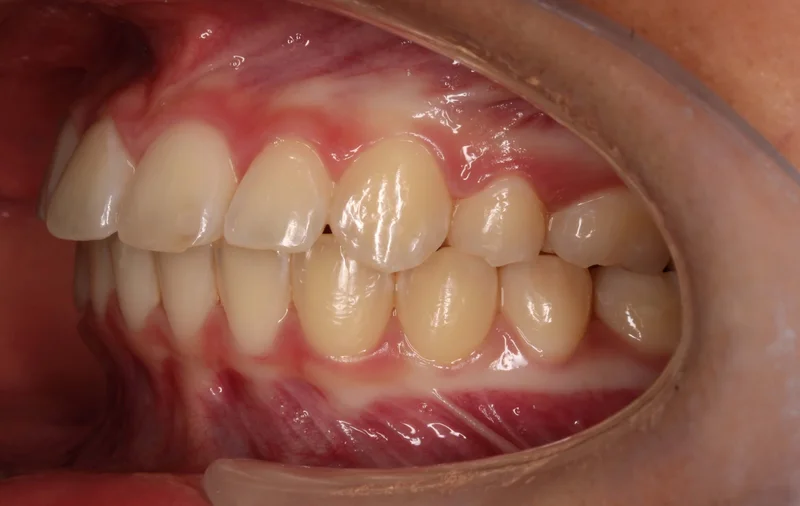 Left Buccal - After Treatment