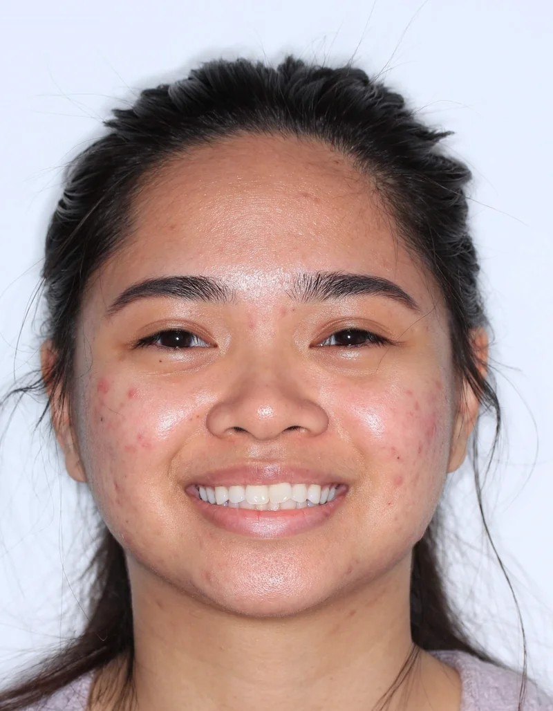Facial Smiling - Before Treatment