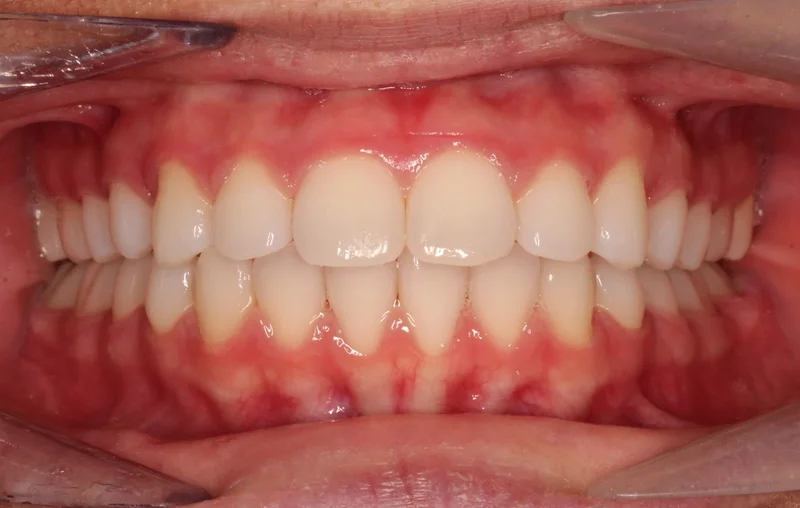 Center Bite - After Treatment