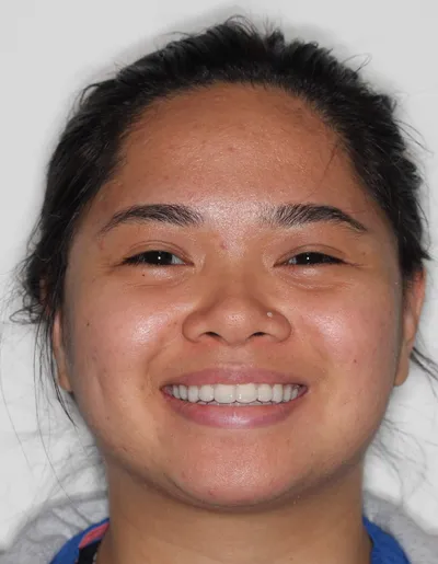 After Metal Braces treatment - Case 85064