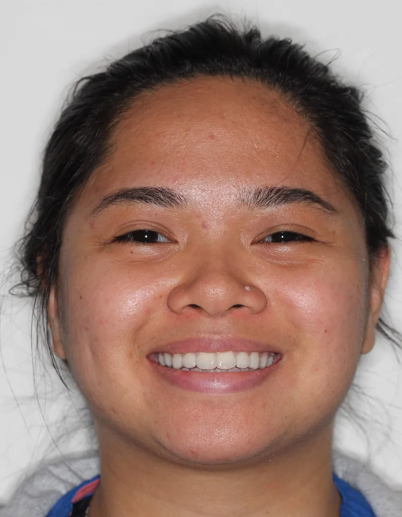 Facial Smiling - After Treatment