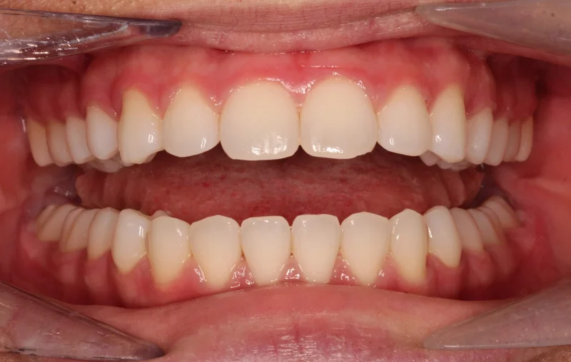 Center Open - After Treatment