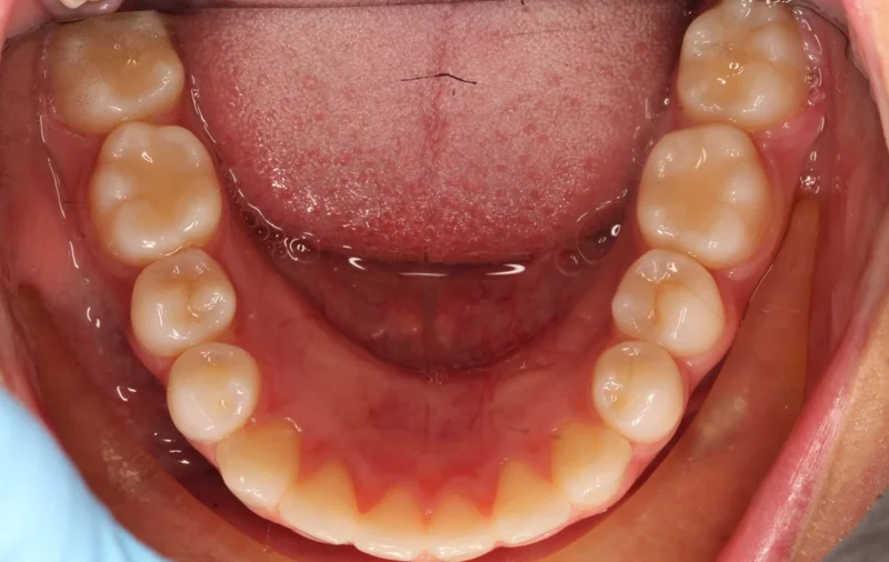 Lower Occlusal - After Treatment