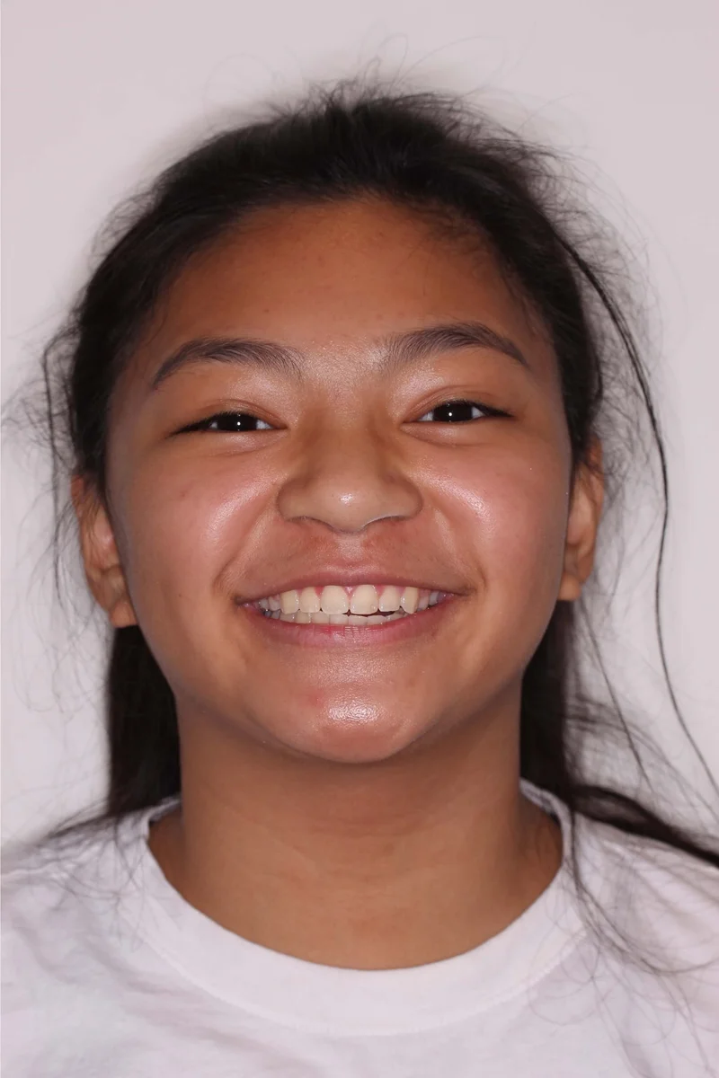 Facial Smiling - Before Treatment