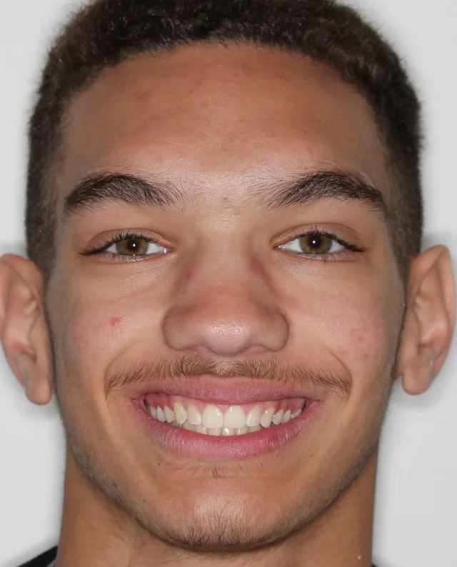 After Removable Clear Aligners treatment - face