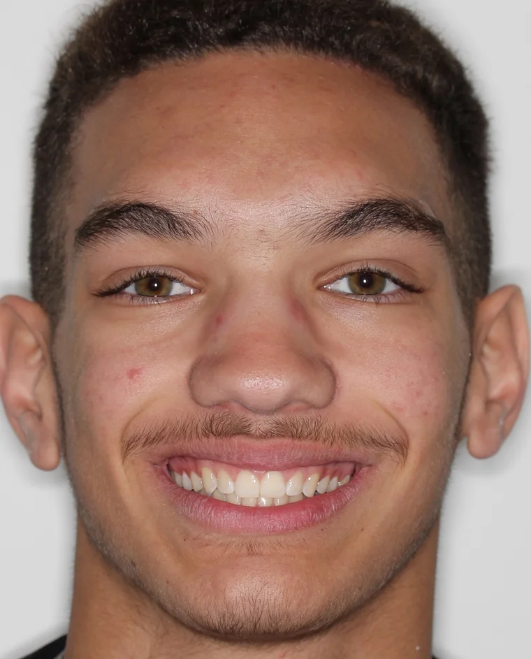 After Removable Clear Aligners treatment - face