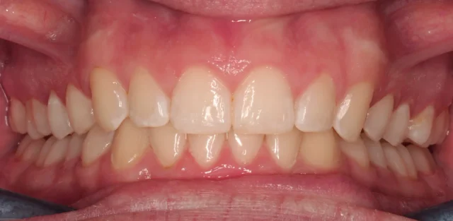 After Removable Clear Aligners treatment - teeth