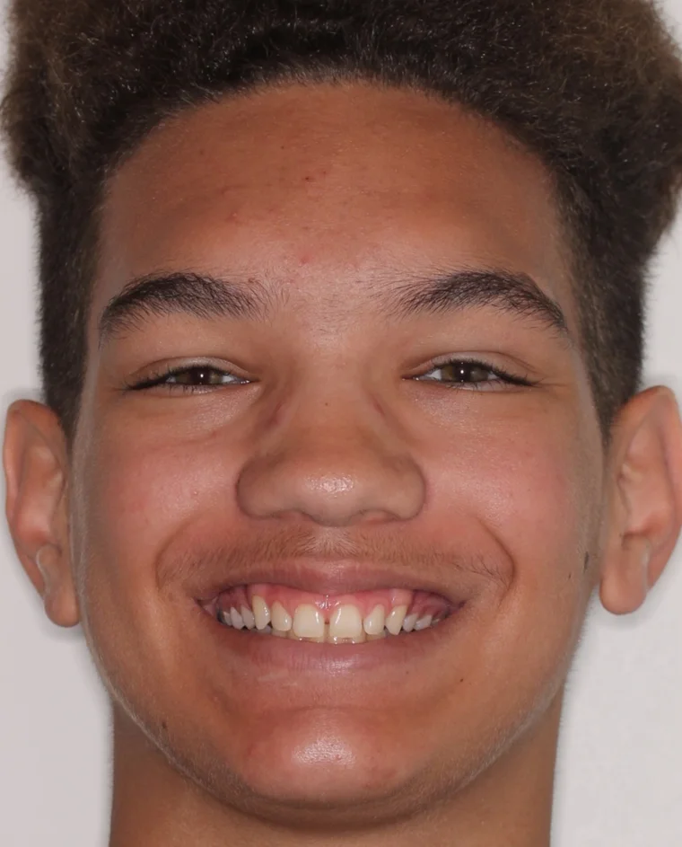 Before Removable Clear Aligners treatment - face