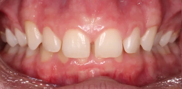 Before Removable Clear Aligners treatment - teeth