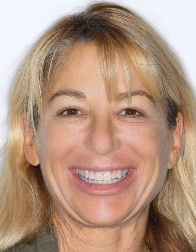 After Removable Clear Aligners treatment - face