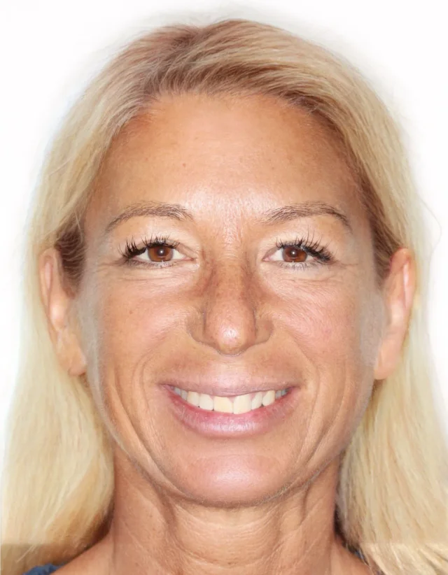 Before Removable Clear Aligners treatment - face