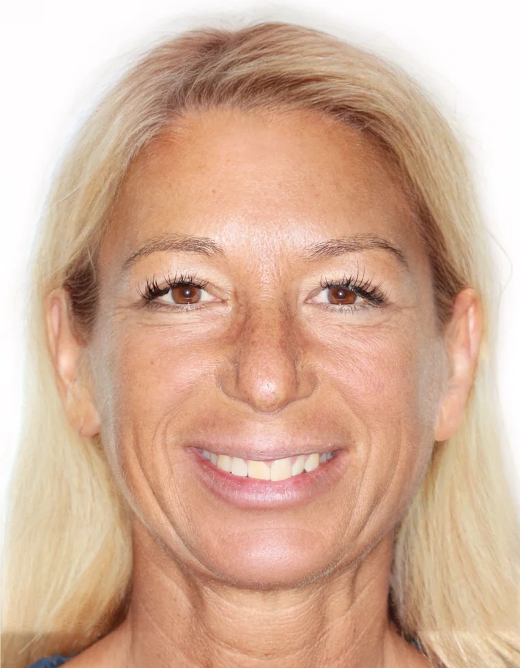 Before Removable Clear Aligners treatment - face