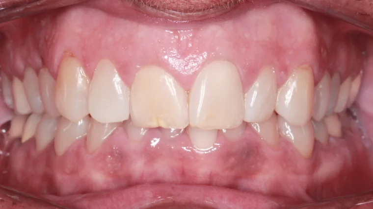 Before Removable Clear Aligners treatment - teeth