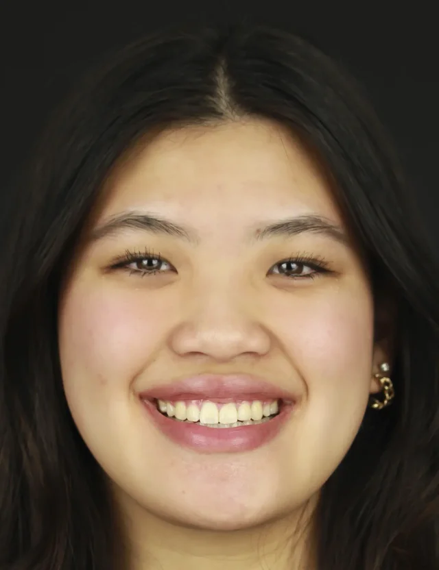 After Metal Self-Ligating Braces & Orthognathic Surgery treatment - face