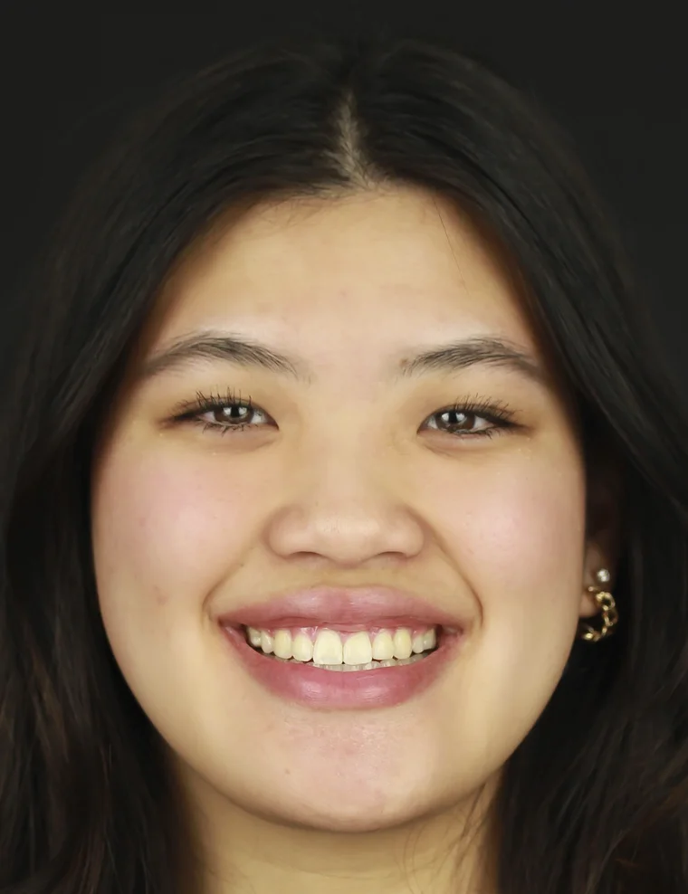 After Metal Self-Ligating Braces & Orthognathic Surgery treatment - face