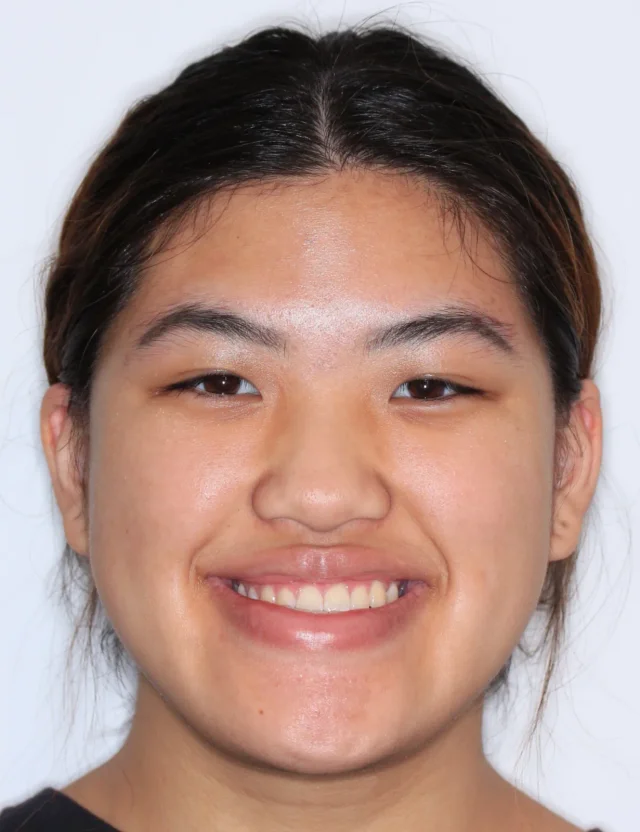 Before Metal Self-Ligating Braces & Orthognathic Surgery treatment - face